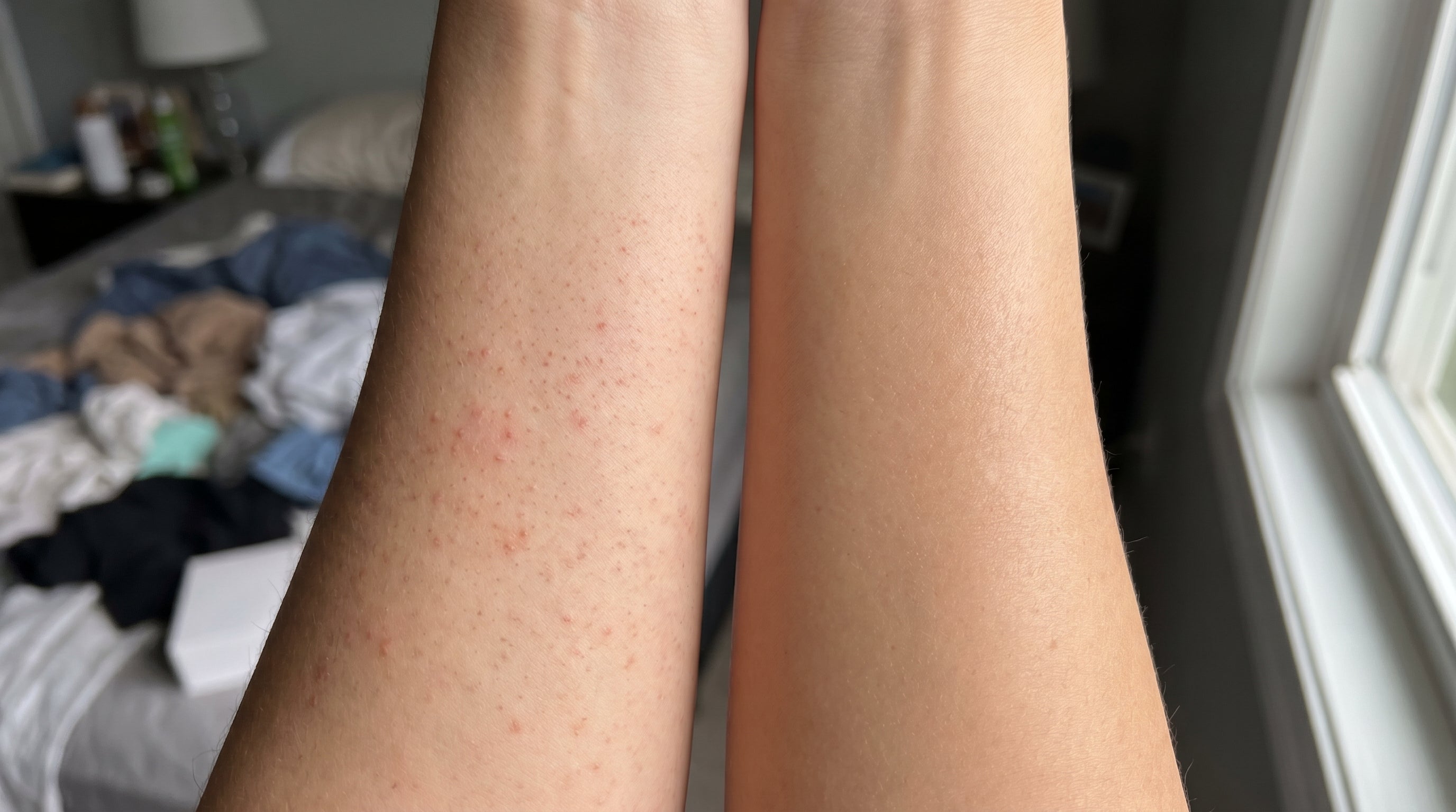 Reibeisenhaut vorher und nachher — links verstopfte Follikel, rechts glatte Haut